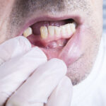 How to Prevent and Treat Tooth Loss?
