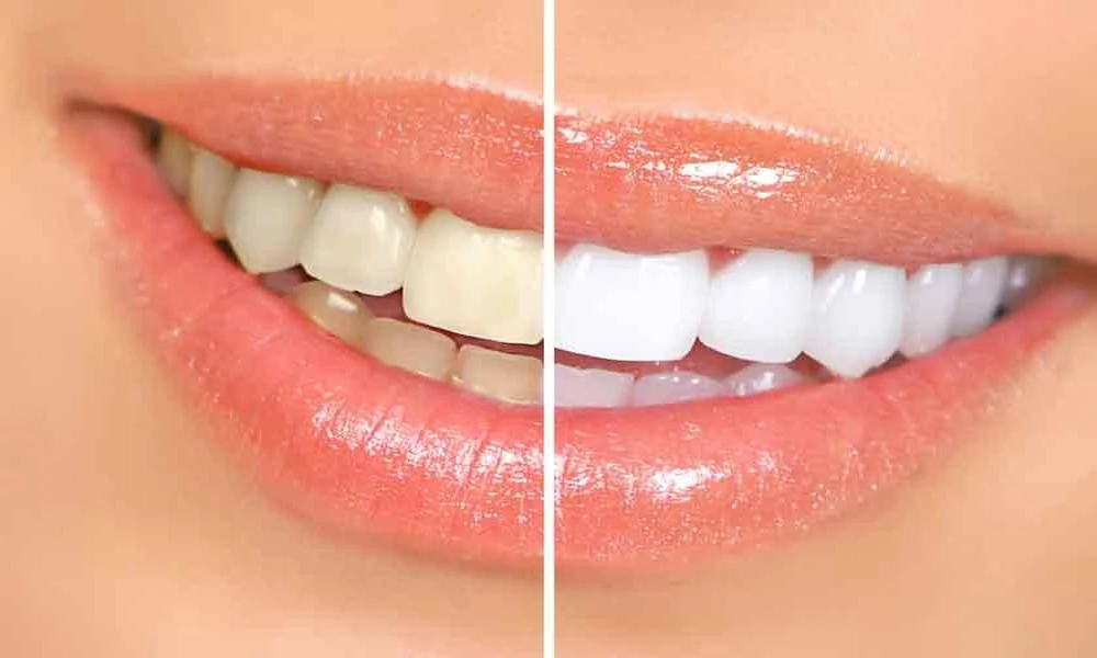 5 Reasons To Consider Cosmetic Dentistry Before A Special Event